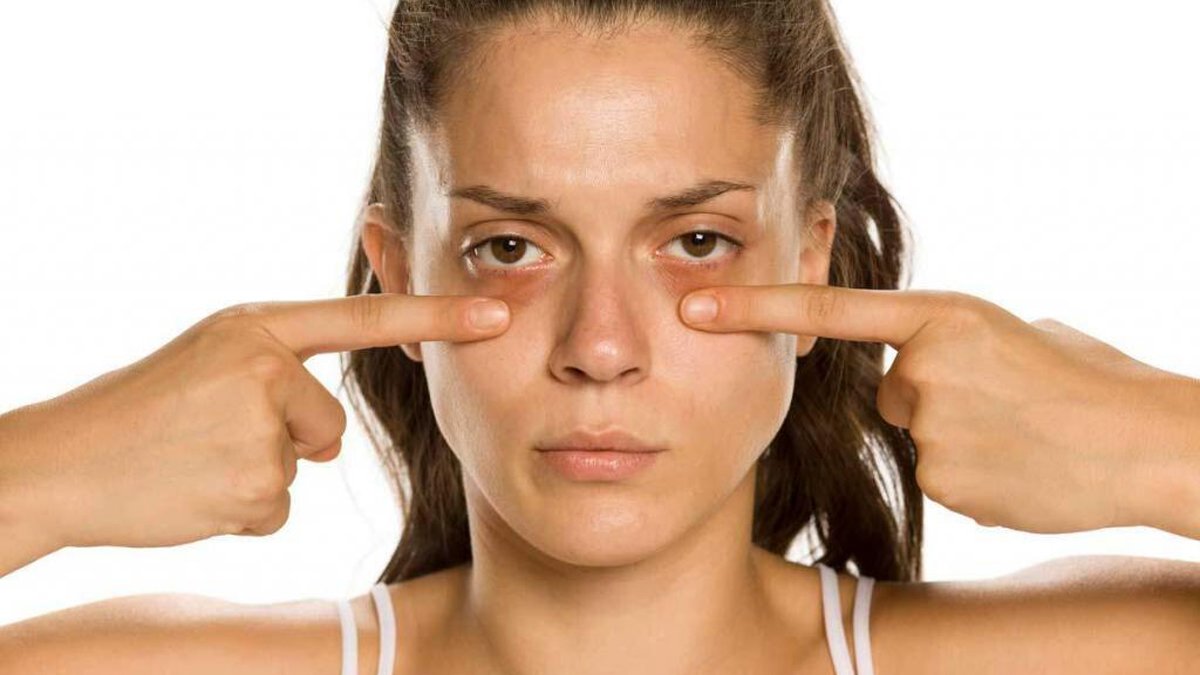 Göz altı morluğu neden olur?