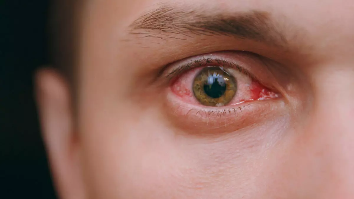 Eğer gözlerinizde sişlik ve akıntı varsa dikkat! Sadece birkaç damlası iltihabı kurutuyor, çapaklanmayı ve şişliği önlüyor