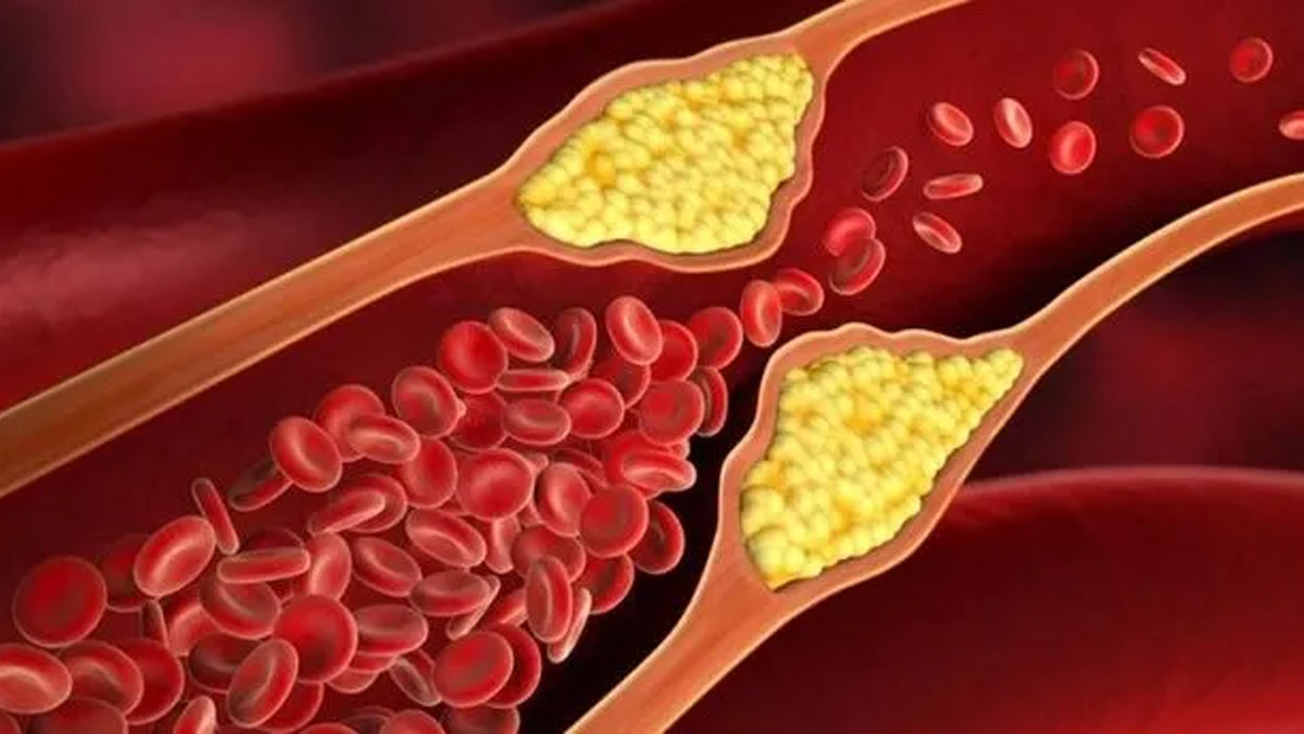Yüksek kolesterol belirtileri