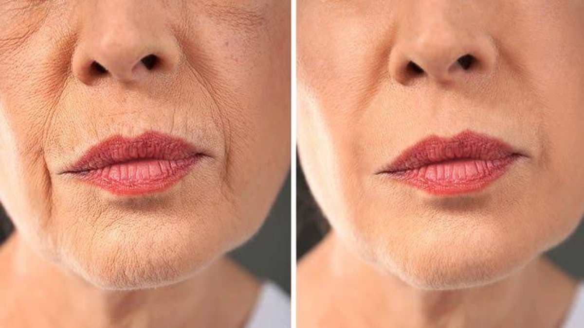 Kırışıklıkları ütü gibi dümdüz yapıyor! Botoksa verdiğiniz para cebinizde kalsın