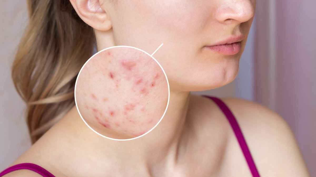 Gül hastalığı nedir?