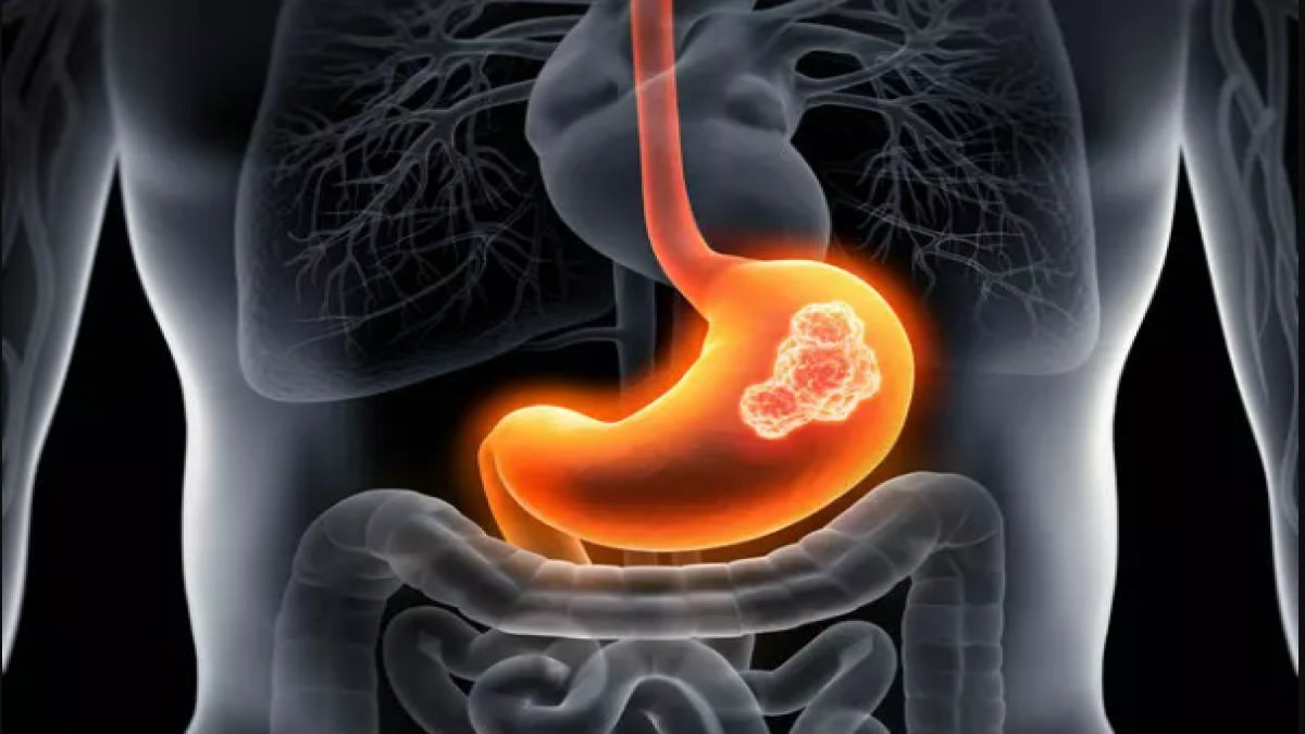 Mide Kanserinin En Kritik Belirtileri