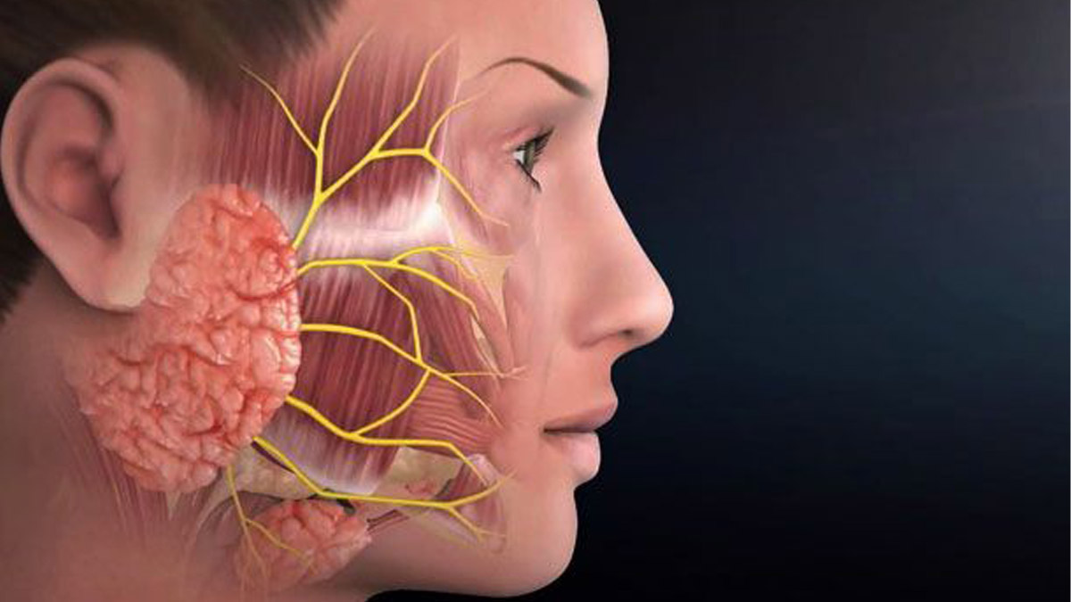 Yüz felci neden olur?