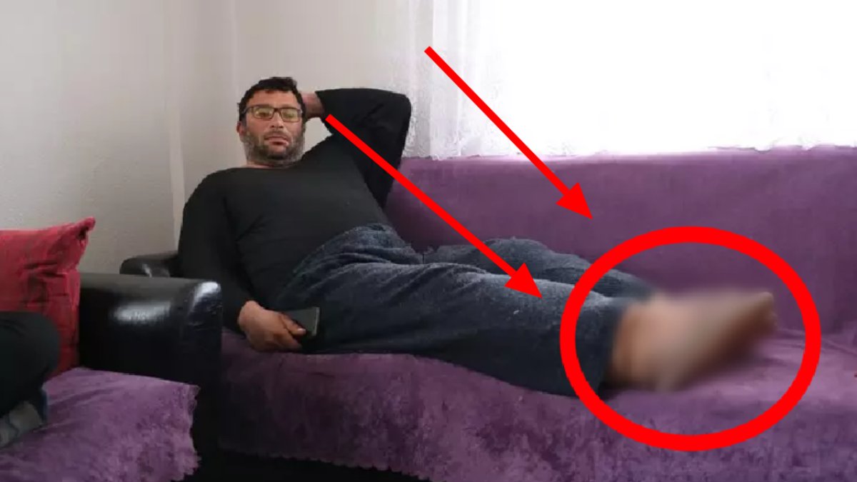 Ayakları her yıl 7 santim büyüyor! Sivas'ta doktorları bile şok eden olay: Fil hastalığı hayatını kabusa çevirdi