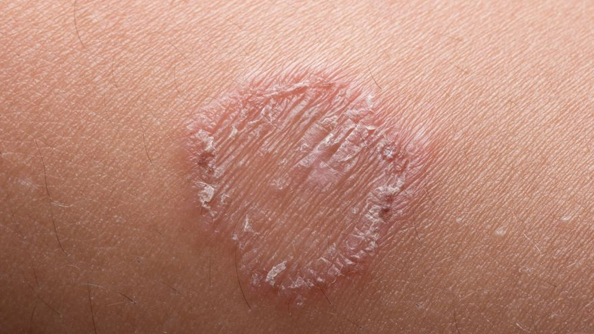 Vücutta mantar nasıl geçer?