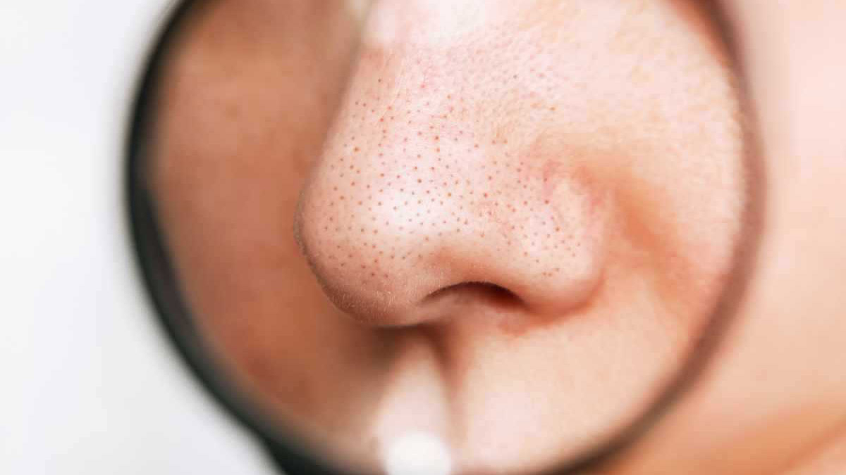 Siyah nokta nasıl geçer?