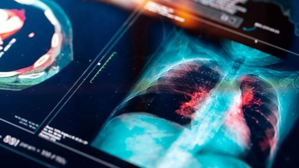 Prof. Tevfik Özlü’den Pnömoni uyarısı: ‘Gizemli virüs’te zatürre riski