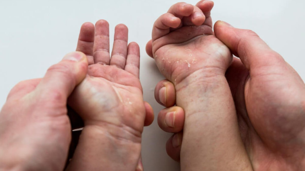 Kızıl Hastalığı: Belirtileri, Tedavisi ve Önleme Yolları