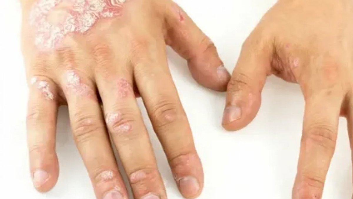 Sedef hastalığı neden olur?