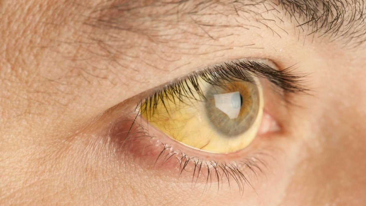 Sarılık neden olur?