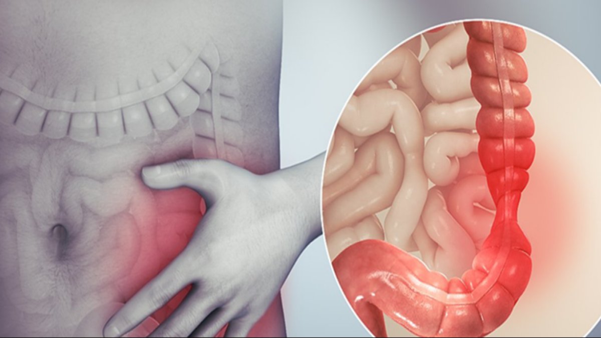 Huzursuz Bağırsak Sendromu Belirtileri: Rahatsızlığı Tanıma Rehberi