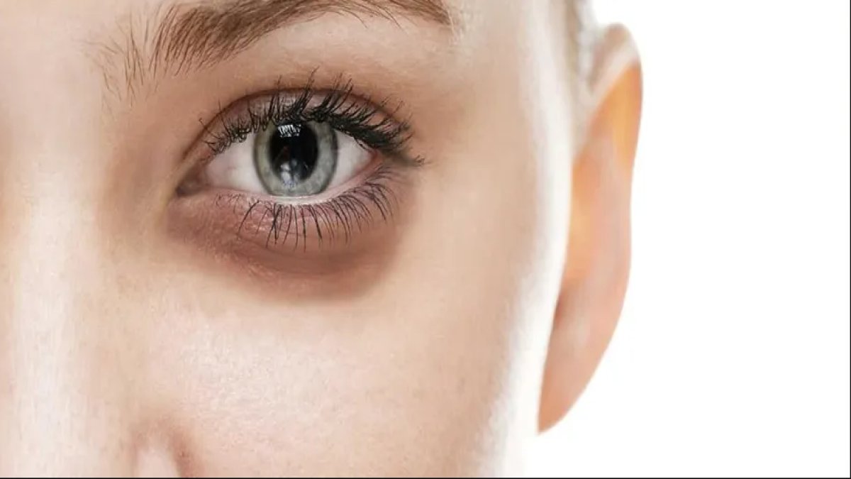 Göz Altı Morluklarına Ne İyi Gelir: Sorunun Üstesinden Gelme Rehberi