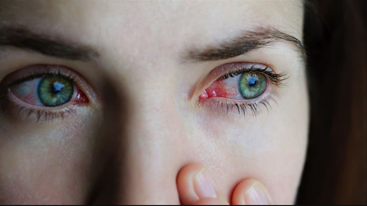 Göz Enfeksiyonu: Belirtiler, Nedenler ve Tedavi Yöntemleri