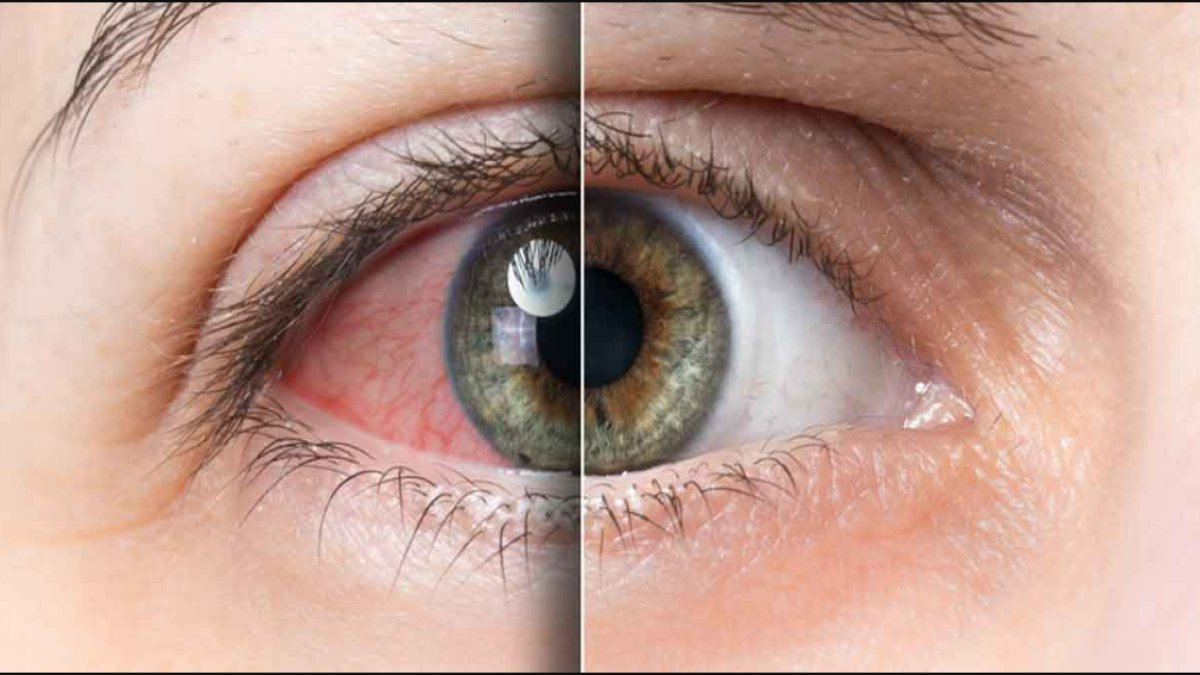 Göz Kanlanması Neden Olur?