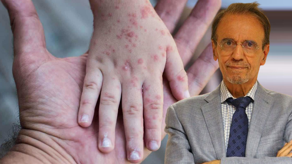 Prof. Dr. Mehmet Ceyhan'dan kızamık hastalığına dikkat çekti: Vaka sayısında Avrupa'da ilk sıradayız