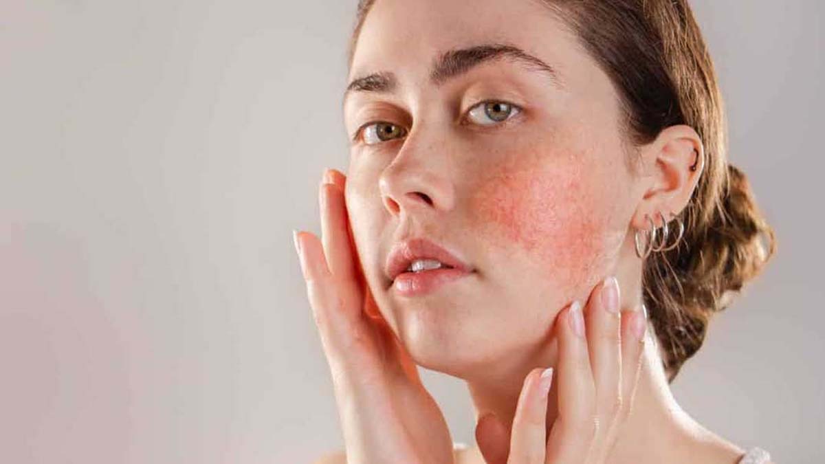 Roza hastalığı nedir?