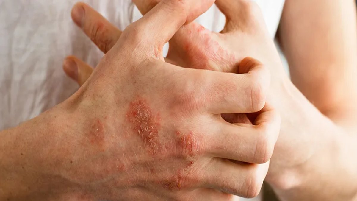 Egzamaya Ne İyi Gelir: Cilt Sorunlarına Doğal Çözümler