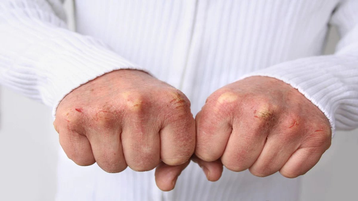 Les mains gercées à cause du froid ne sont plus un problème ! Personne ...