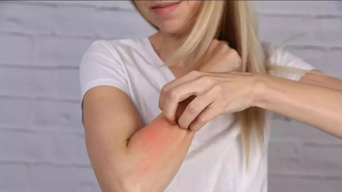 Alerjiye Ne İyi Gelir: Doğal Çözümler ve Öneriler