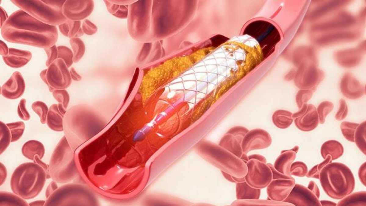 Anjiyo Nasıl Yapılır: Sağlık İçin Önemli Bir Tanı Yöntemi