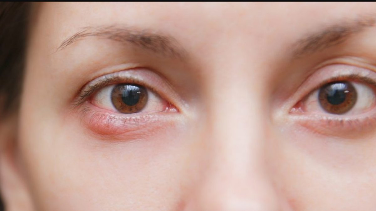 Arpacık Nasıl Geçer: Sorunun Kökenleri ve Etkili Tedavi Yöntemleri