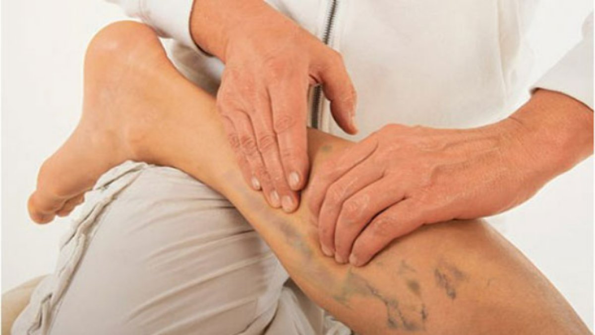 Bacakta Damar Tıkanıklığı Belirtileri: Tanı ve Tedavi Yolları