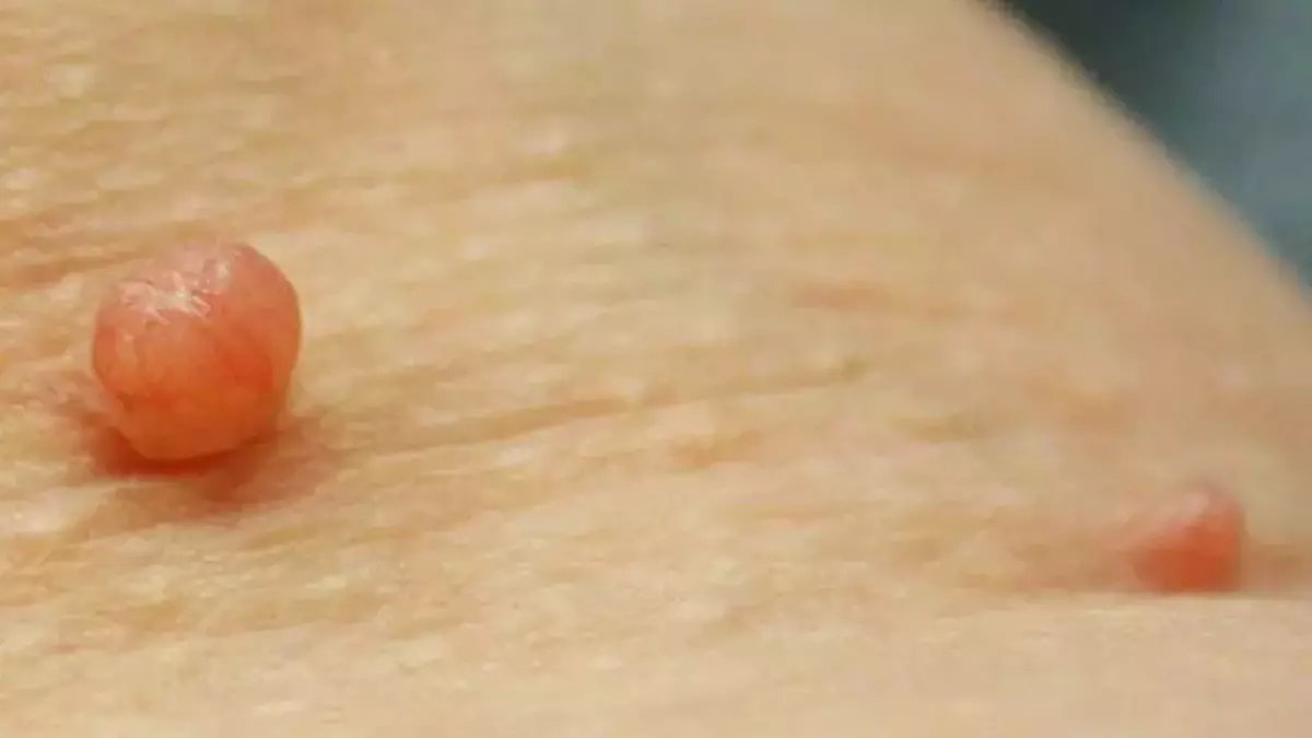 Et benlerini ameliyat gerektirmeden kolayca düşürecek yöntem bulundu! Bu doğal yöntemle çok kolay: Evdeki iki malzemeyle...