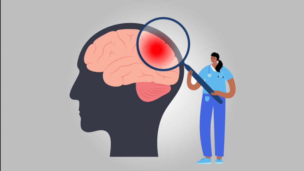 Beyin Tümörü Belirtileri: Tanı ve Tedavi Yöntemleri