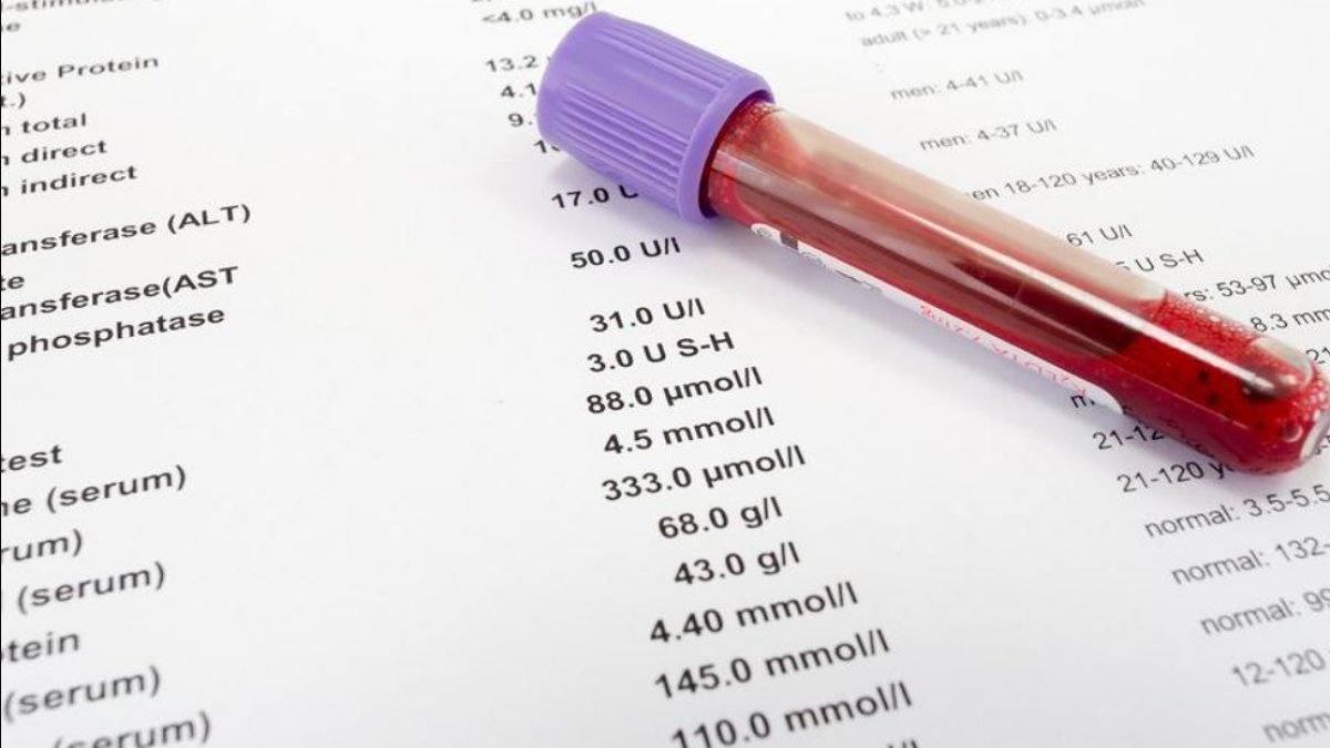 Bilirubin Total Nedir: Karaciğer Fonksiyonları ve Sağlık İçin Önemi