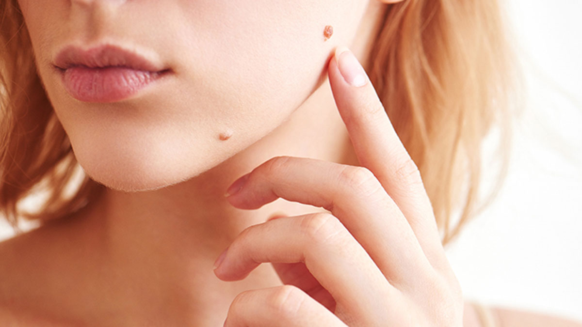 Cildinizde kırmızı renkli ben çıkmaya başladıysa geçmiş olsun! Meğer nedeni buymuş