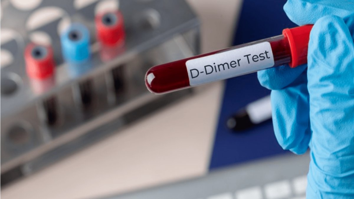 D Dimer Nedir? – Kan Pıhtılaşması ve İnflamasyon Belirteci