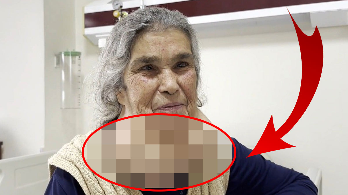 Doktordan korktuğu için 50 yıl boynundaki devasa kitleyle yaşadı! Doktorlar bile şaştı kaldı