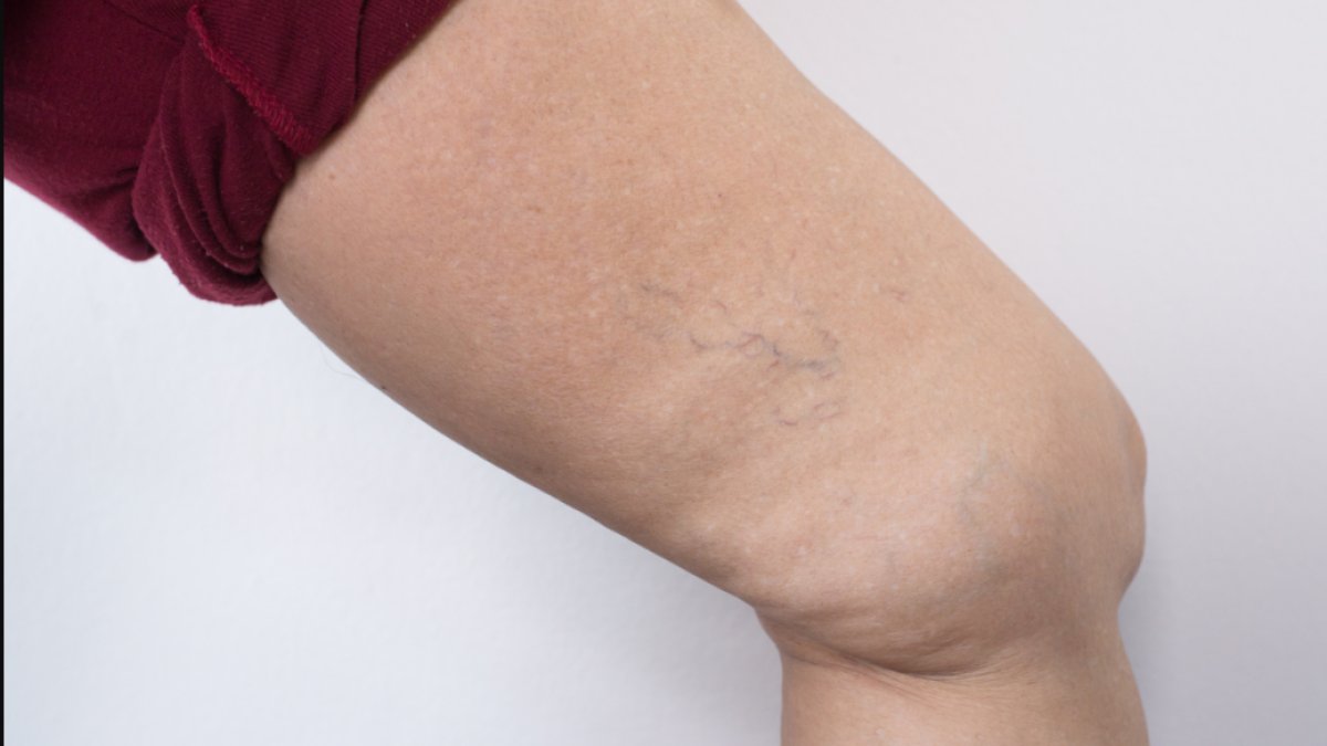 Damar Tıkanıklığı Belirtileri: Sağlığınızı Korumanın Anahtarı