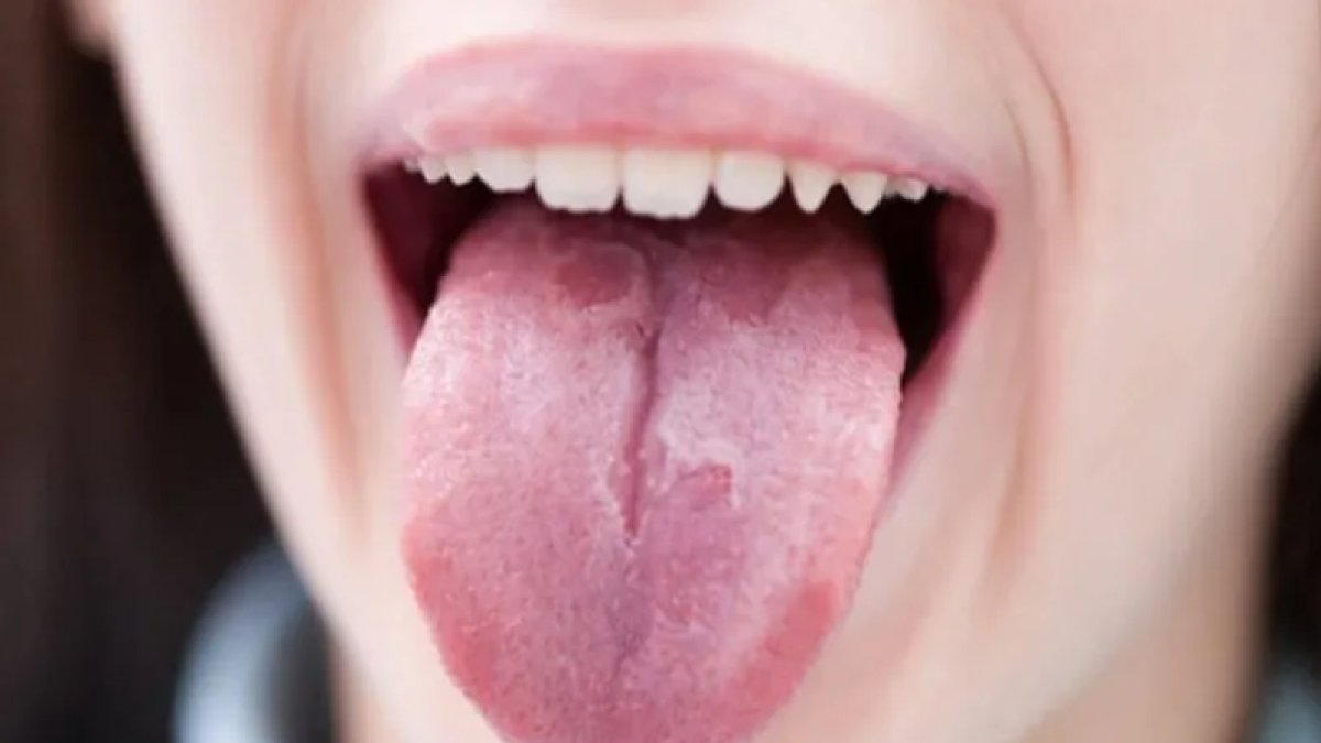 Dil Kanseri Belirtileri: Tanı ve Tedavi Yolları