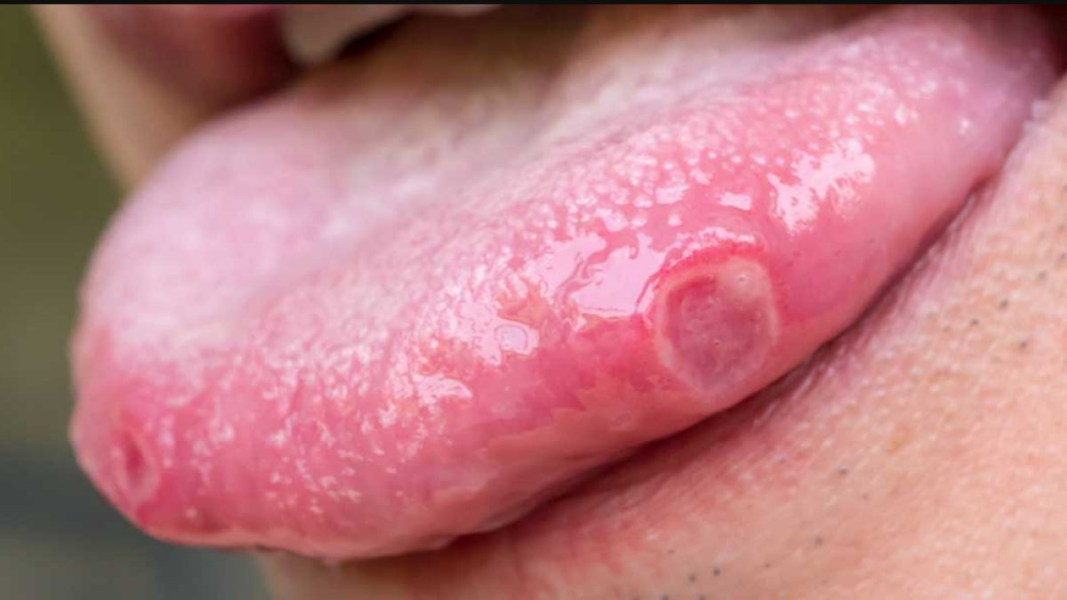 Dil Yarasına Ne İyi Gelir: Sık Karşılaşılan Bir Sorunun Çözümü