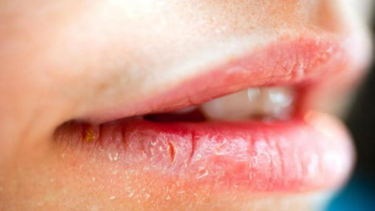 Dudak Kuruluğu Neden Olur: Sebepler ve Çözümler