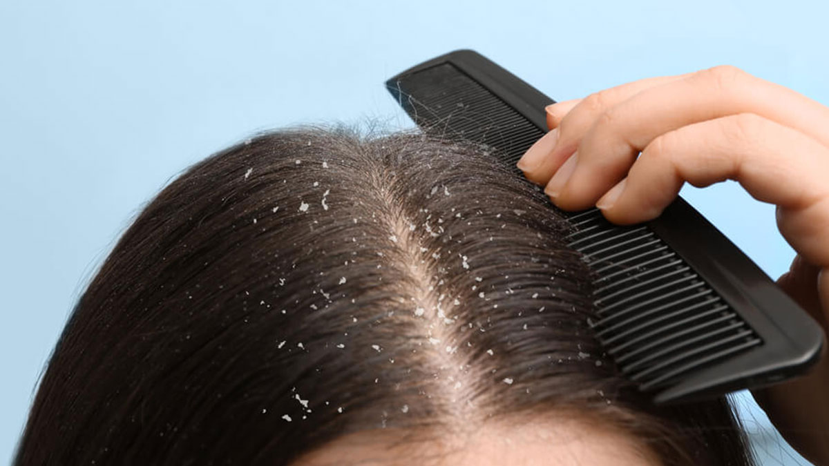 Saçtaki kepeklenmeden o baharatla sonsuza kadar kurtulun! Meğer doğal yöntemle bu kadar kolaymış