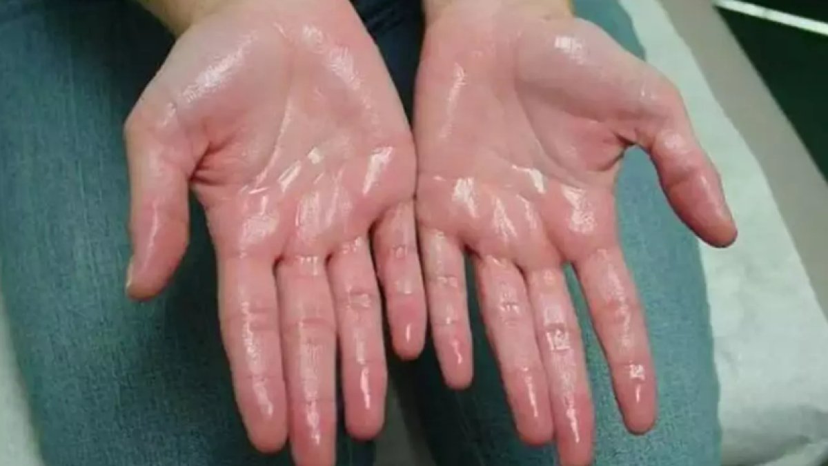 El Terlemesi Neden Olur: Sebepleri ve Çözüm Yolları