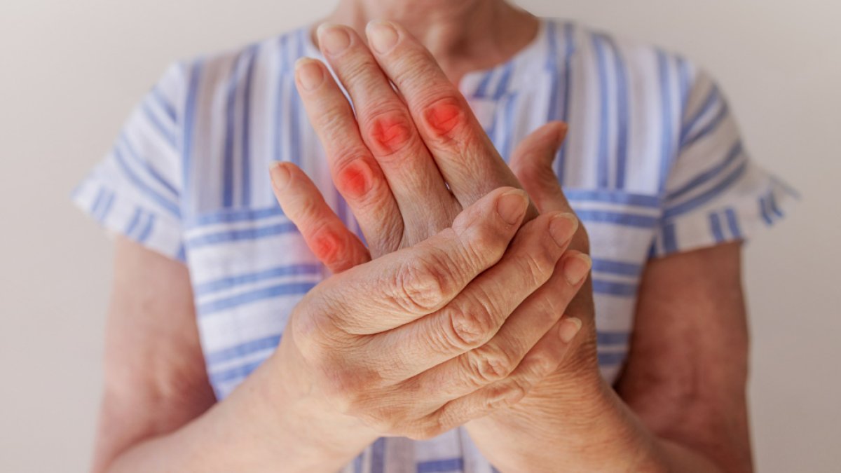 El Yanığına Ne İyi Gelir: Doğal Tedavi Yöntemleri