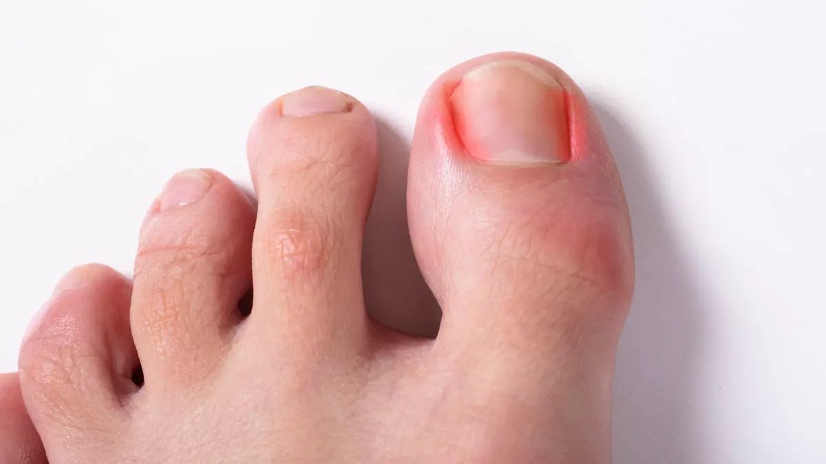 Tırnak batması artık sorun olmaktan çıkacak! Tek seferde yok ediyor: O ürün herkesin evinde var