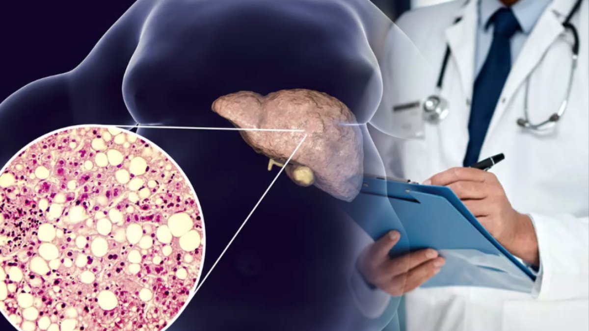 Uzmanlar uyarıyor! Karaciğer yağlanmasına sebep oluyor: Nefes darlığına kadar gidiyor