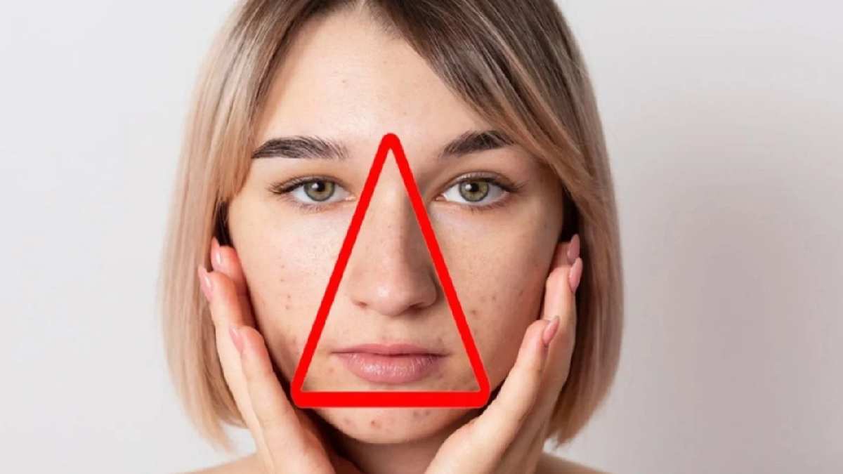Yüzünüzdeki bu üçgene sakın dokunmayın! Resmen ölüm saçıyor! Sivilce sıkayım derken hayatınızı karartmayın