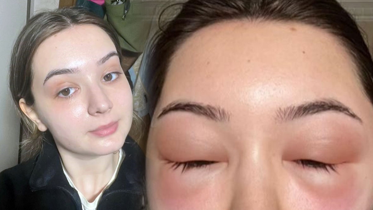 Marketten aldığı saç boyasını sürünce hayatı kabusa döndü! Gözleri kapandı, yüzü şişti, saç derisi döküldü