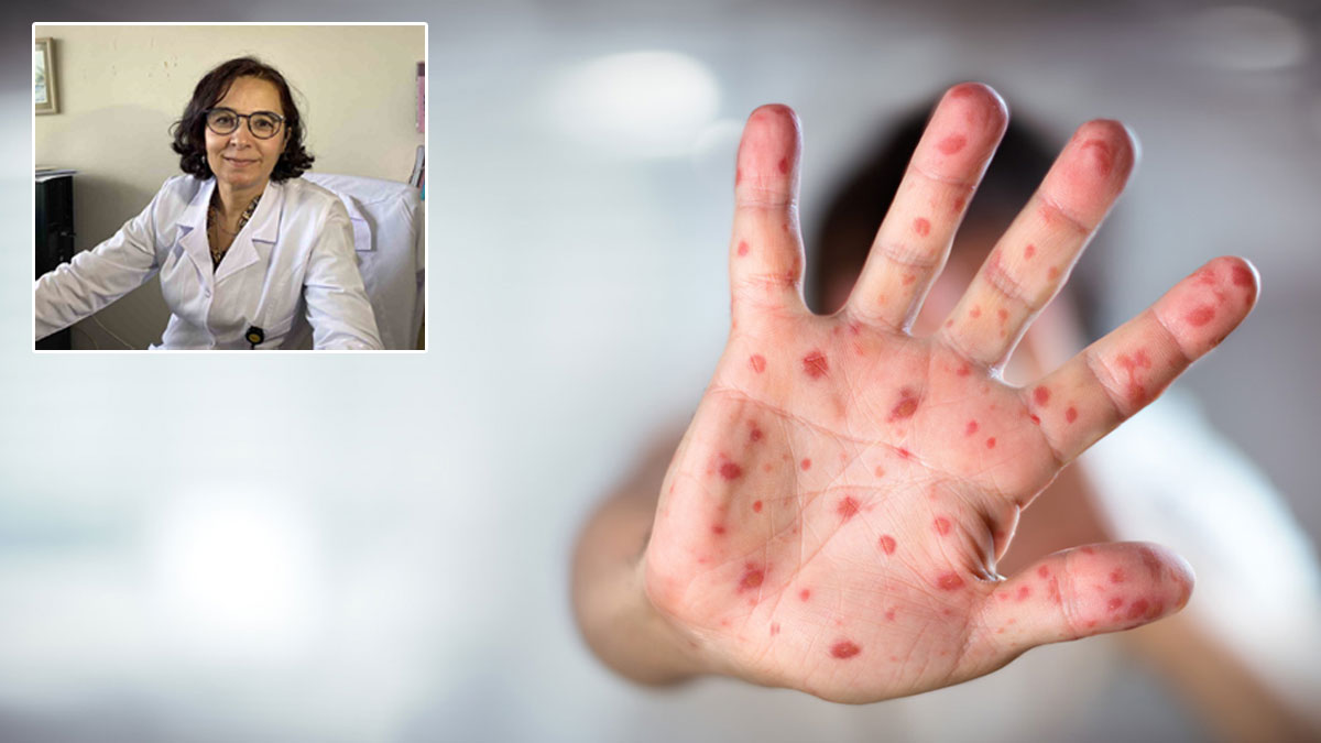 Prof. Dr. Yavuz'dan 'kızamık' uyarısı: Vakalar en çok İstanbul'da