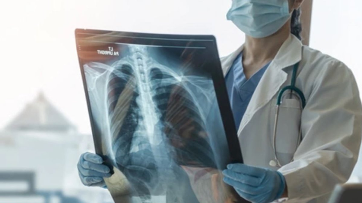 Yılda 41 bin kişi akciğer kanseri