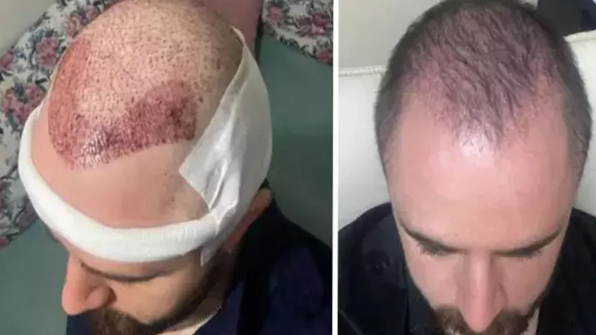 Mahkemeden ‘saç ekiminde’ emsal karar: ‘Ayıplı işlem, parası iade edilsin’