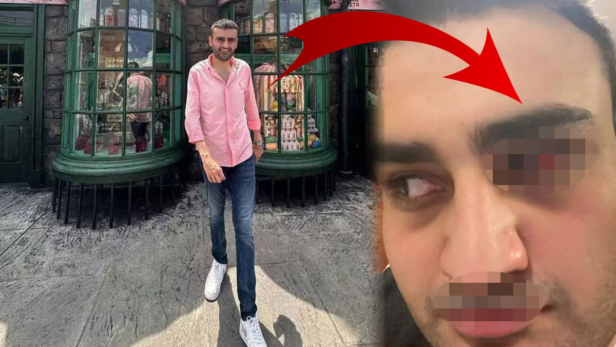 Gözünden yaralanan CZN Burak korkuttu! Paylaşımına öyle bir not yazdı ki herkes şaştı kaldı