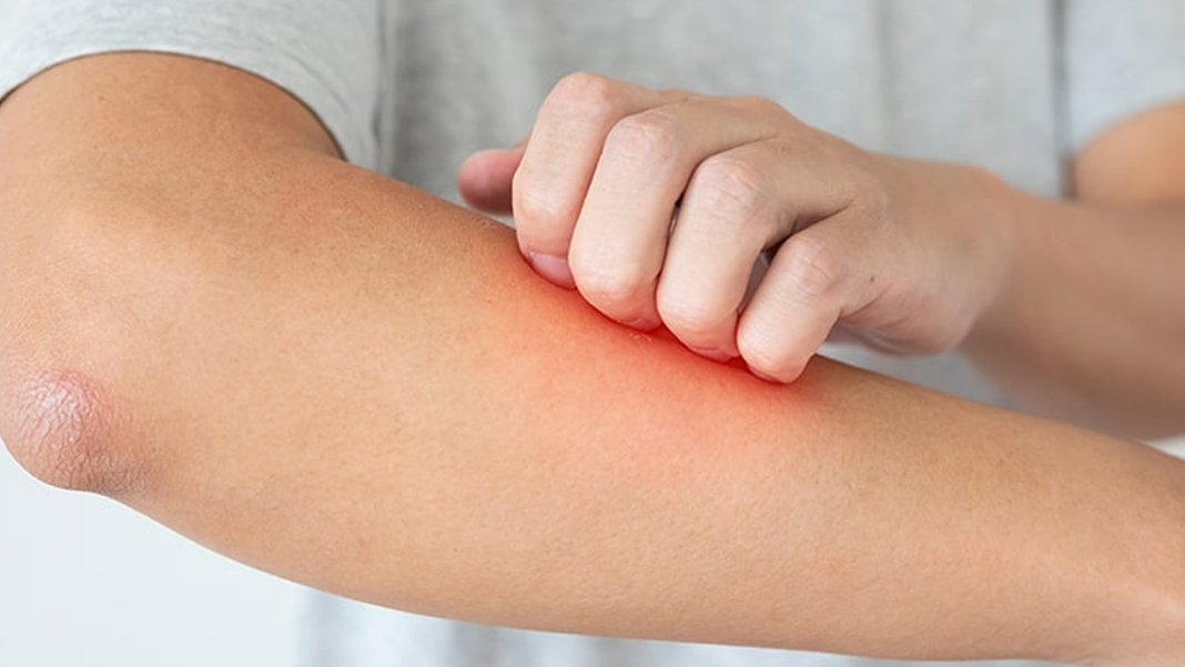 Böyle hastalık görülmedi: Kendine karşı alerjisi var