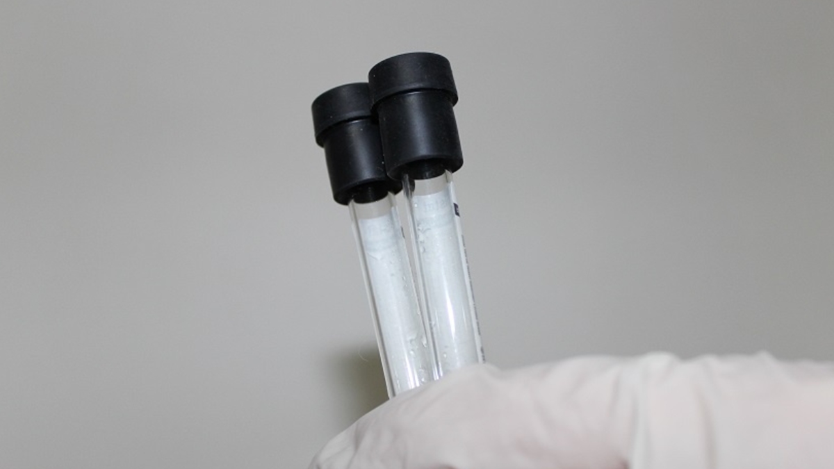 Homosistein testi nedir?