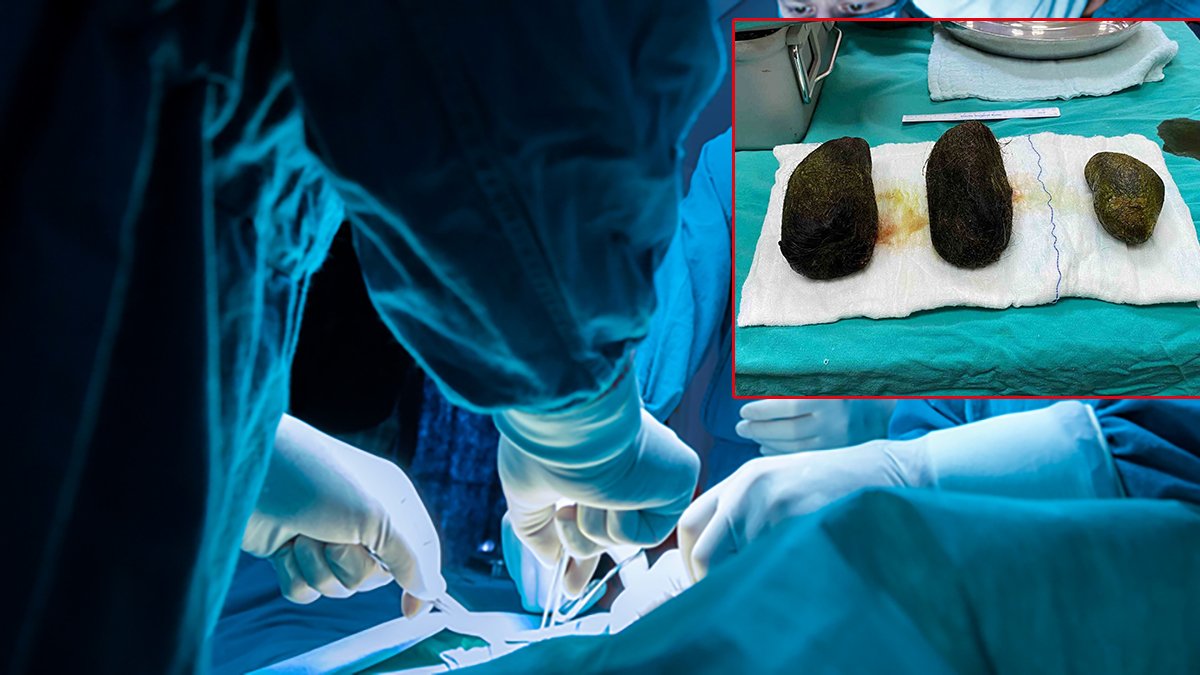 Karın ağrısı şikayetiyle hastaneye gitti: Midesinden tam 2 kilo kıl çıktı!